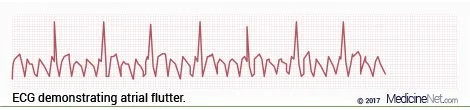 Atrial Flutter